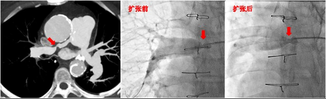 国内首例！齐鲁医院完成大动脉炎肺动脉置换术后再狭窄患者的介入治疗