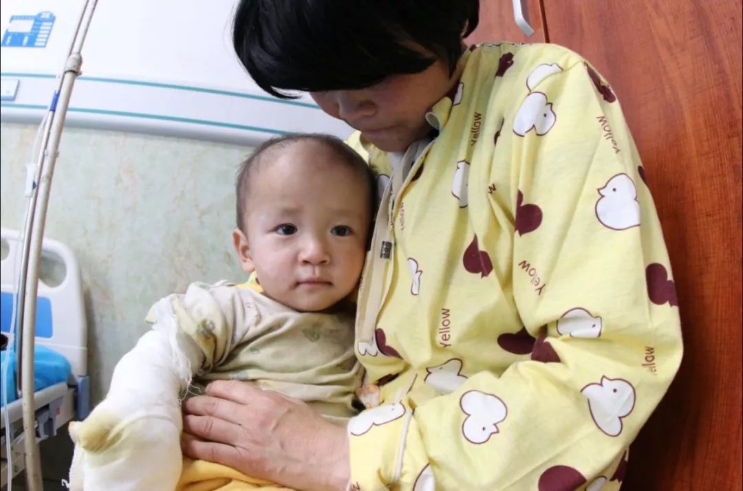 热粥烫伤1岁半男孩手 热心的青岛市民坐不住了！