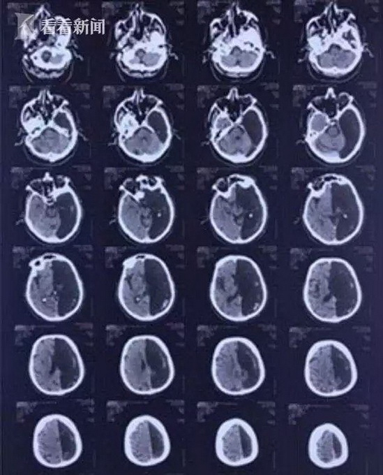 男子CT显示左脑是空的！啥也没有……竟靠半个大脑存活了60年？