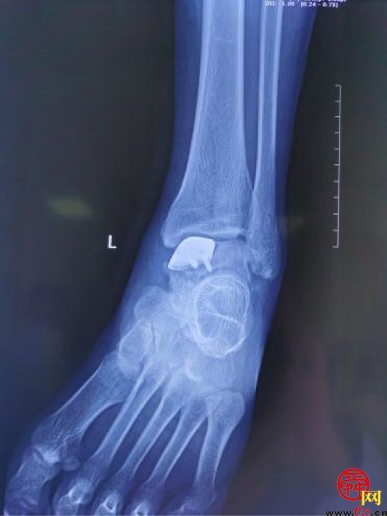 山东大学齐鲁医院成功完成国内首例3D打印距骨半髁置换手术