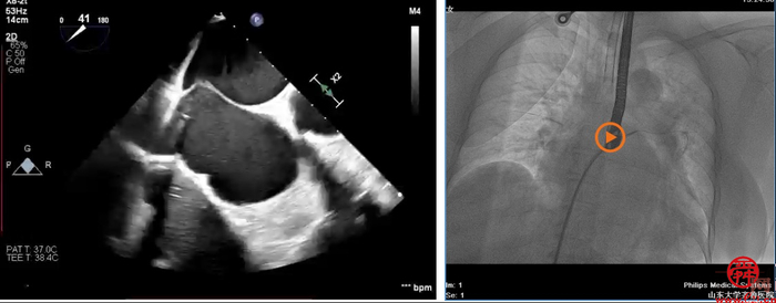 齐鲁医院安贵鹏副教授团队连续完成2例高难度经导管二尖瓣钳夹术