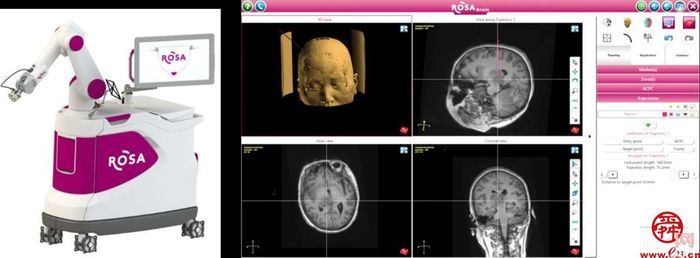 省内首例！医院完成首台ROSA ONE机器人辅助神经外科丘脑病变活检微创手术