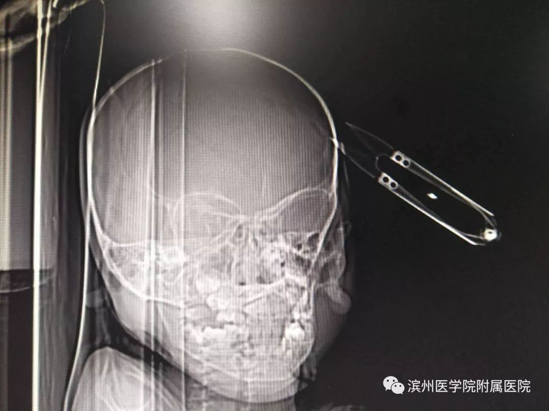 滨州一2多岁的小孩拿剪刀玩，不慎跌倒插入脑袋……