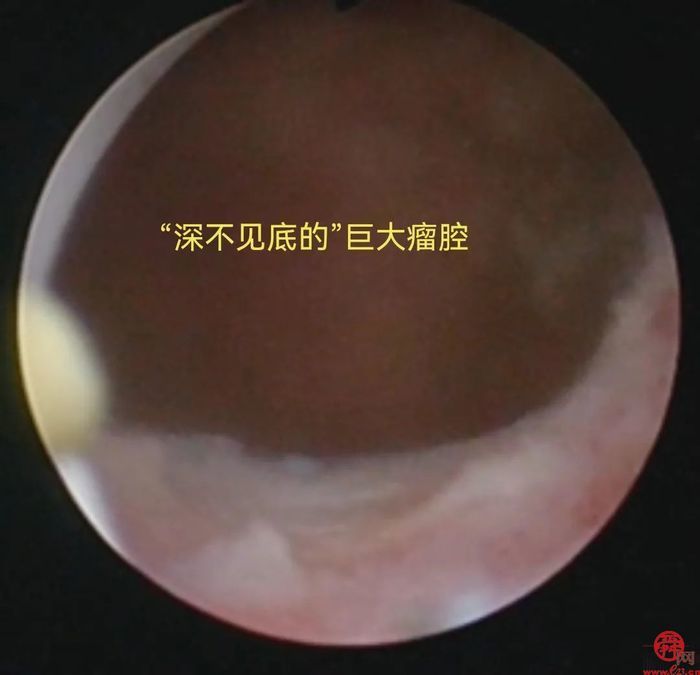 巧夺天“宫”——记济南市第五人民医院妇科顺利完成“天花板”级别经宫腔镜子宫肌壁间肌瘤电切术1例