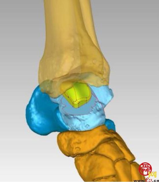 山东大学齐鲁医院成功完成国内首例3D打印距骨半髁置换手术