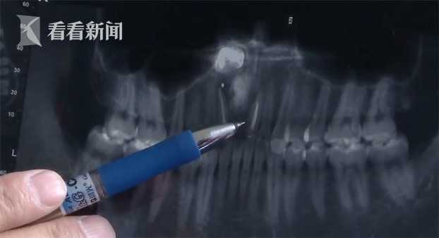 罕见！男子做假牙拍片意外发现鼻腔边长了颗牙(图)