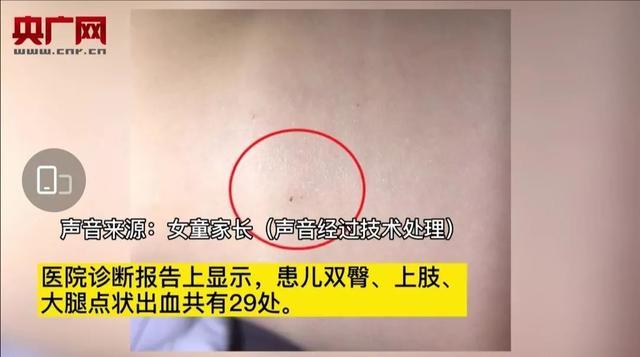 29个针眼！谁扎的？到底要怎么保护我们的孩子？