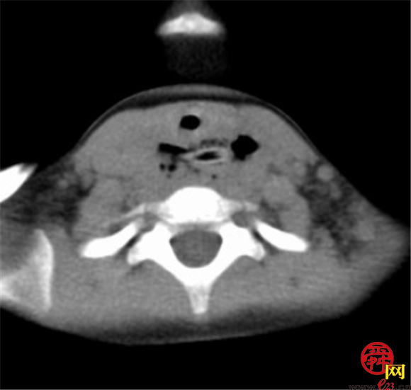 2岁娃误吞数枚枣核食管穿孔 齐鲁儿医紧急手术转平安