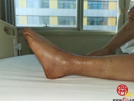 山东大学齐鲁医院成功完成国内首例3D打印距骨半髁置换手术