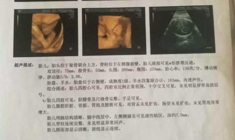 两次产检没问题，孩子出生后吓到了！现在只能爬行...