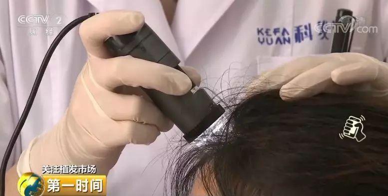 中国脱发人群超2.5亿 植发能否挽救“头顶大事”？