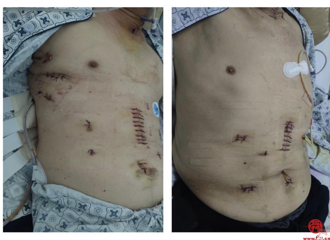 山东第一医科大学附属省立医院胸外食管外科成功开展两例充气式纵膈镜食管癌手术
