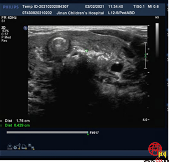 2岁娃误吞数枚枣核食管穿孔 齐鲁儿医紧急手术转平安