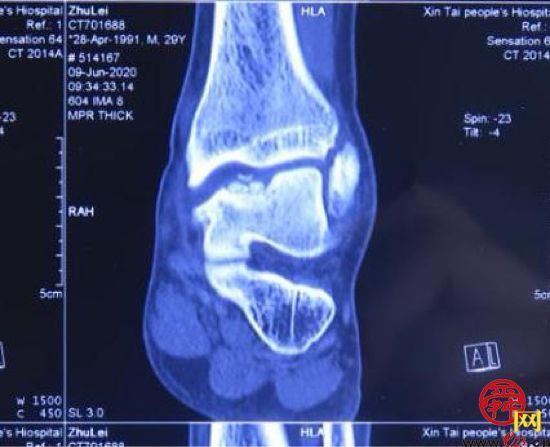 山东大学齐鲁医院成功完成国内首例3D打印距骨半髁置换手术