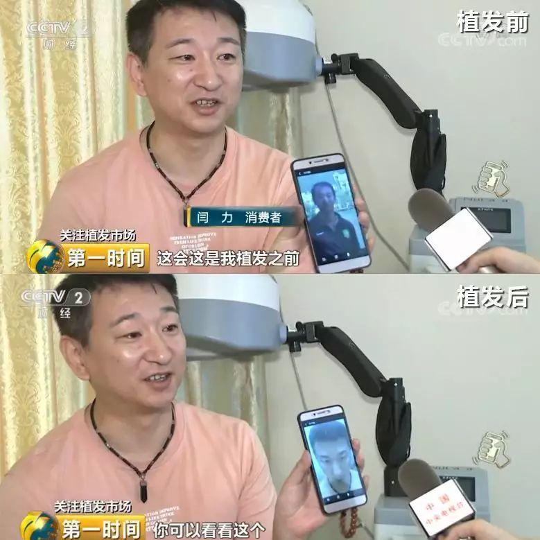 中国脱发人群超2.5亿 植发能否挽救“头顶大事”？