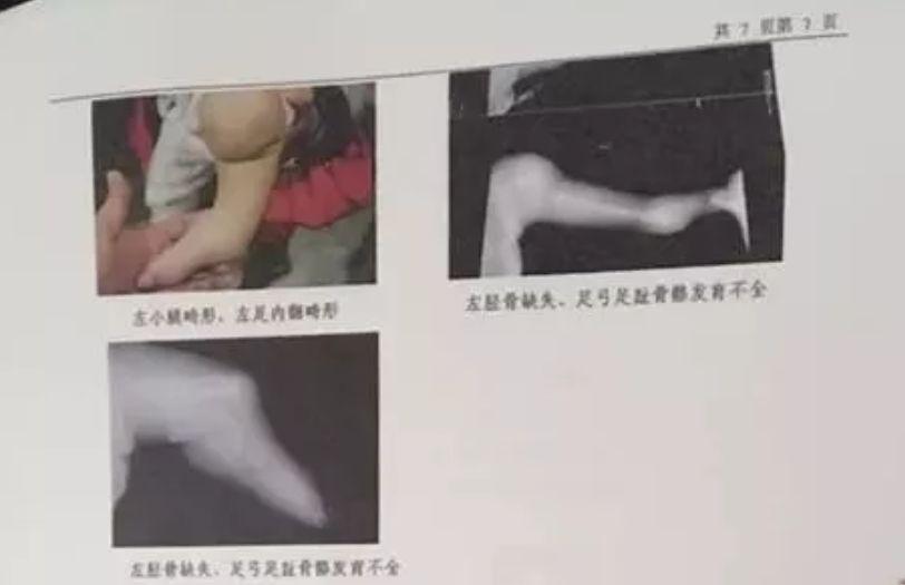 两次产检没问题，孩子出生后吓到了！现在只能爬行...