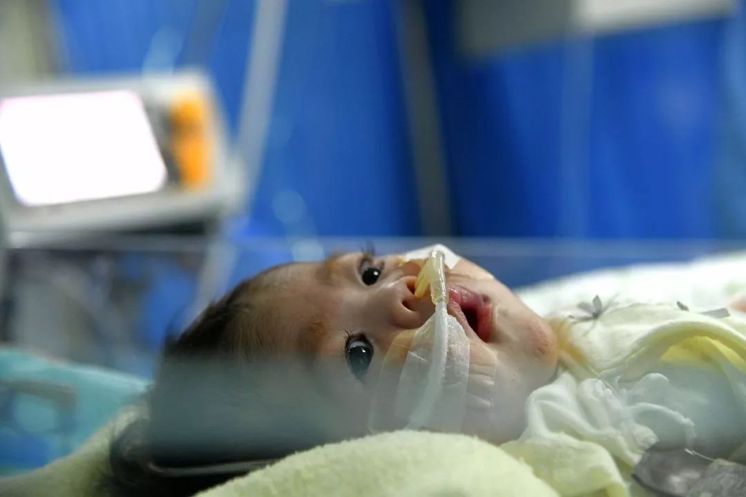 66天大女婴换上4岁男童心脏，创造的纪录令人泪朦胧