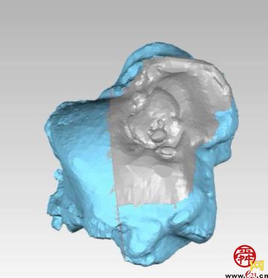 山东大学齐鲁医院成功完成国内首例3D打印距骨半髁置换手术