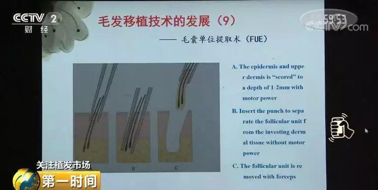 中国脱发人群超2.5亿 植发能否挽救“头顶大事”？