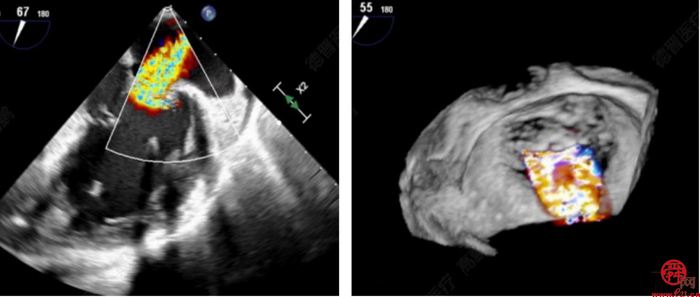 齐鲁医院安贵鹏副教授团队连续完成2例高难度经导管二尖瓣钳夹术