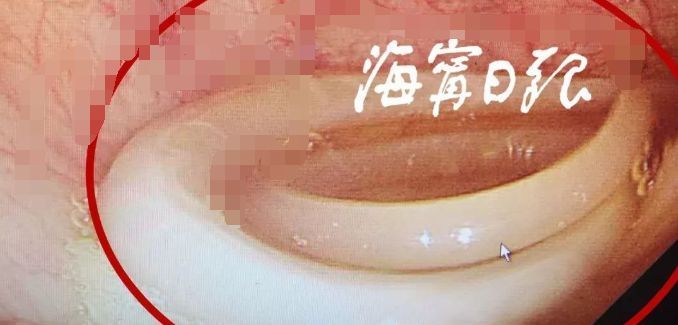 女子肚子痛了10多年，一查医生都吓一跳，腹中这条寄生虫可不小