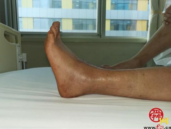 山东大学齐鲁医院成功完成国内首例3D打印距骨半髁置换手术