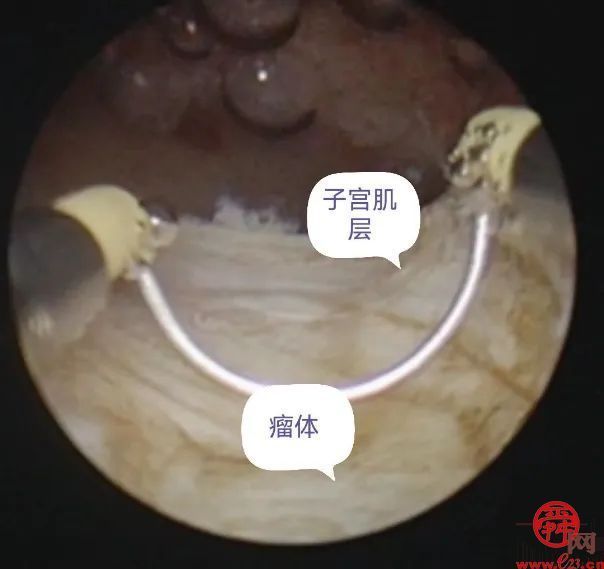 巧夺天“宫”——记济南市第五人民医院妇科顺利完成“天花板”级别经宫腔镜子宫肌壁间肌瘤电切术1例