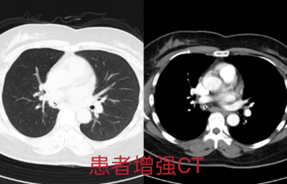 体内藏异物长达40年！山东省第二人民医院成功为患者“取物”解顽疾