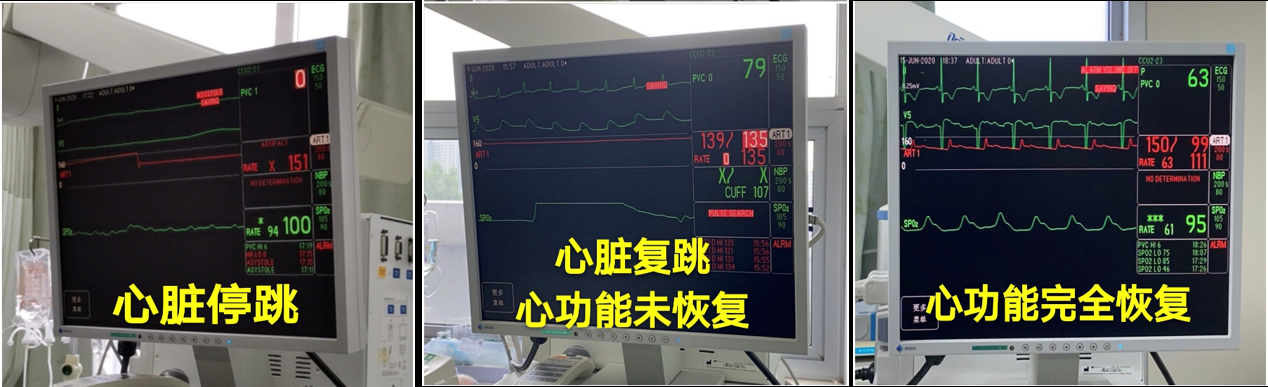 23岁女子心脏停跳3天奇迹治愈|生命奇迹!23岁女子心脏停跳3天奇迹治愈 具体是怎么回事？