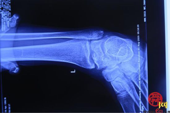 山东大学齐鲁医院成功完成国内首例3D打印距骨半髁置换手术