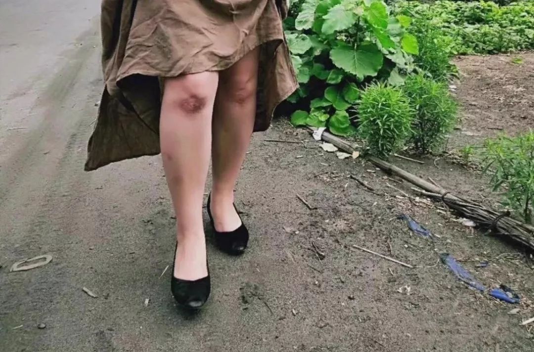 她跪地40分钟，膝盖破了都不顾，就为…这是我见过最美的伤疤！