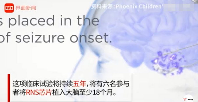 大脑中植入芯片减肥？外国科学家给过胖者植脑芯片：灭掉贪吃念头