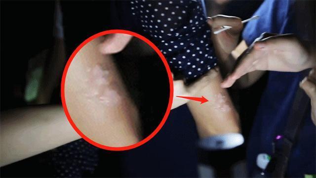 桂纶镁拍戏不慎“深二度烧伤”，手臂冒泡强忍疼痛不停工