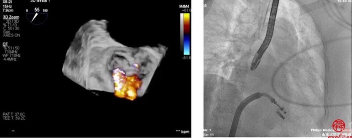 齐鲁医院安贵鹏副教授团队连续完成2例高难度经导管二尖瓣钳夹术