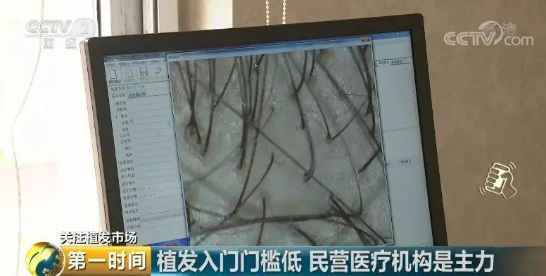 中国脱发人群超2.5亿 植发能否挽救“头顶大事”？