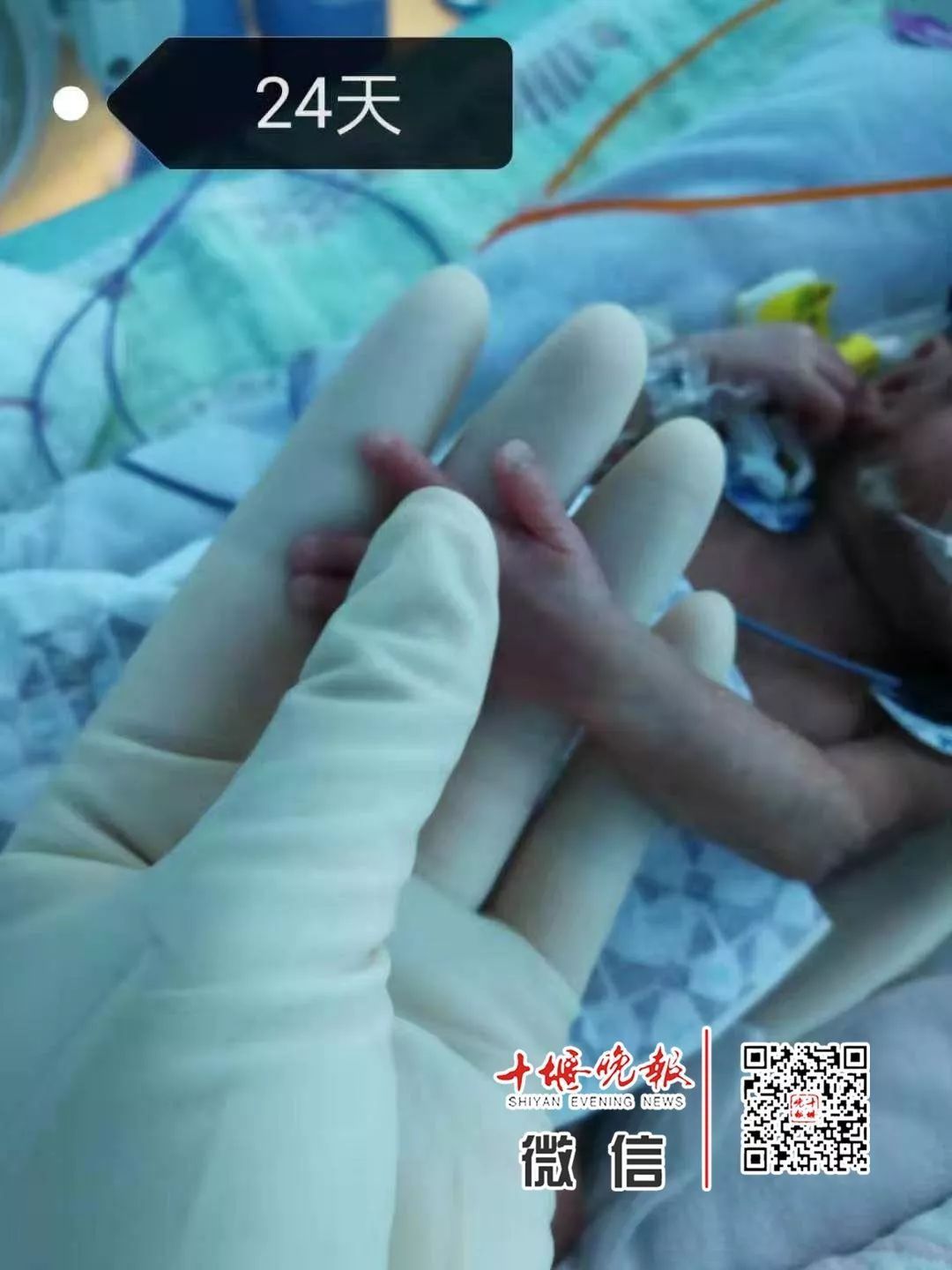 妈妈怀孕6个月产下巴掌大女婴！医生拍下14张照片，张张让人落泪……