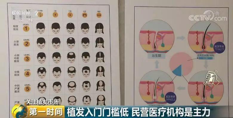 中国脱发人群超2.5亿 植发能否挽救“头顶大事”？