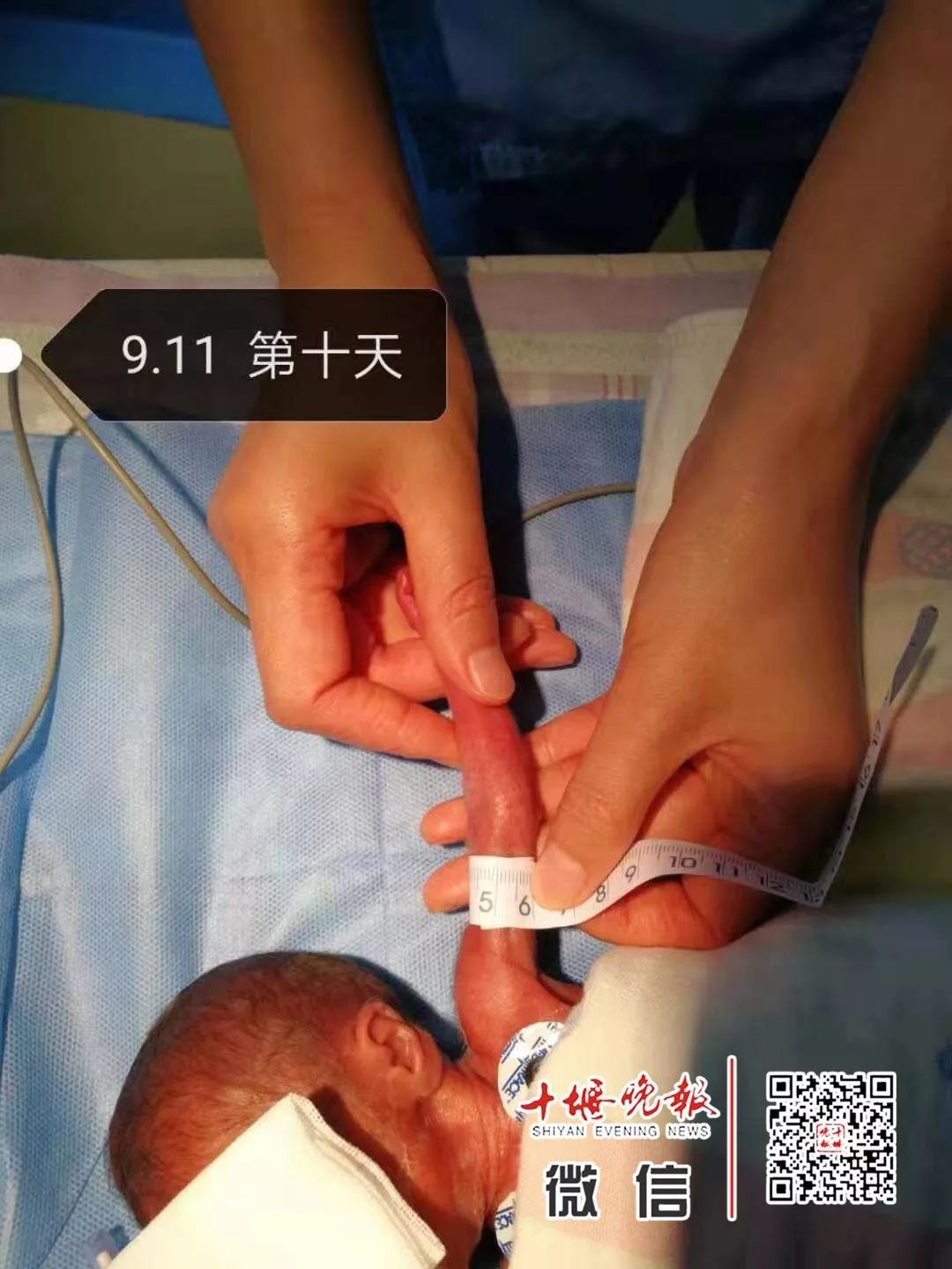 妈妈怀孕6个月产下巴掌大女婴！医生拍下14张照片，张张让人落泪……