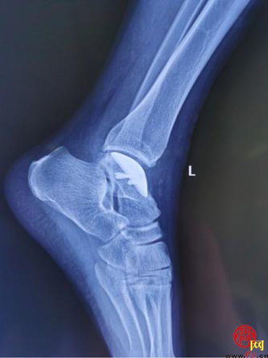 山东大学齐鲁医院成功完成国内首例3D打印距骨半髁置换手术