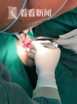 罕见！男子做假牙拍片意外发现鼻腔边长了颗牙(图)