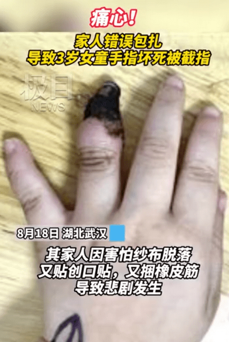 心疼！家人错误包扎致3岁女童手指坏死