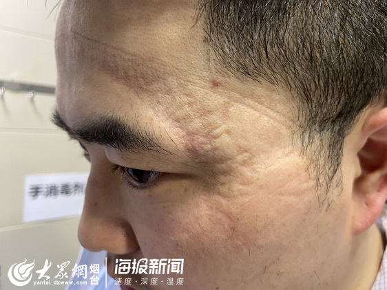 这就是山东丨医者手记：深深勒痕是我们的“战书”