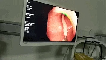 女子肚子痛了10多年，一查医生都吓一跳，腹中这条寄生虫可不小