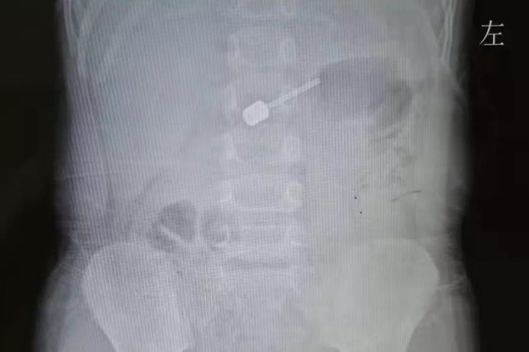 紧急！三岁宝宝吞球针 山东一医生连夜赶回医院救治