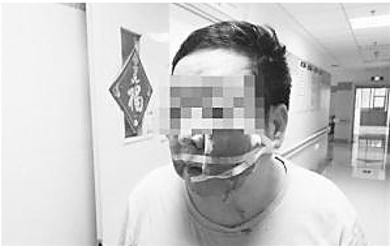 “越狱”泼猴大闹城区咬伤3人 严重者缝一百多针