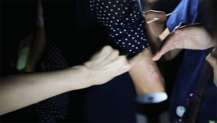 桂纶镁拍戏不慎“深二度烧伤”，手臂冒泡强忍疼痛不停工