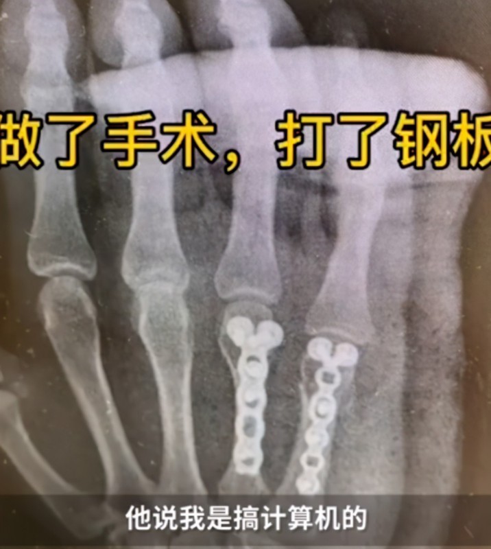 爸爸辅导孩子作业生气捶墙致骨折用事实告诉孩子爸爸多残忍