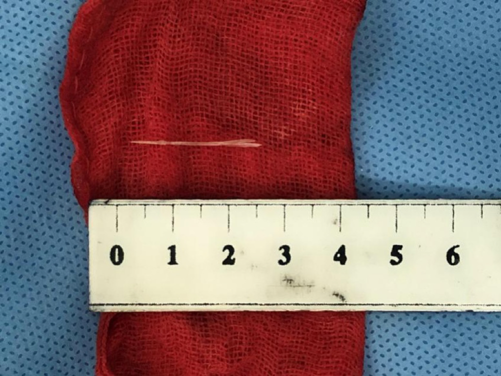 喝酒时吃了一口家常菜，男子花50多万才保住命！医生紧急提醒……