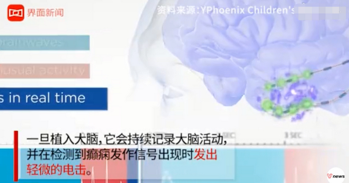 大脑中植入芯片减肥？外国科学家给过胖者植脑芯片：灭掉贪吃念头