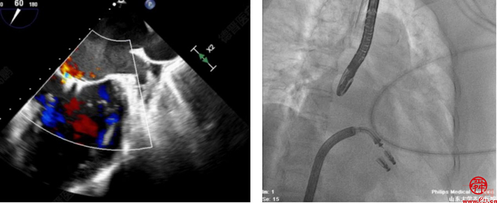 齐鲁医院安贵鹏副教授团队连续完成2例高难度经导管二尖瓣钳夹术